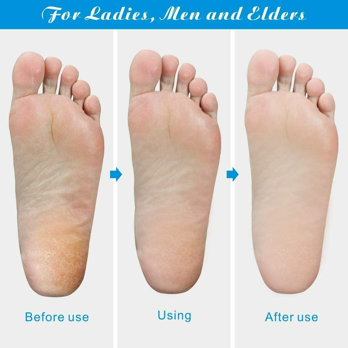 Foot File Callus Remover Pedicure Tool